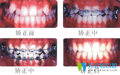 湛江南方口腔牙齒矯正前后效果對(duì)比圖
