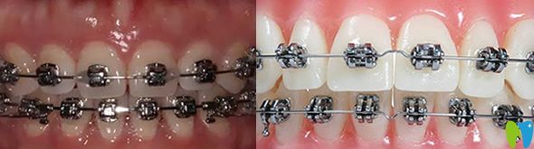 矯正牙齒自鎖托槽和傳統(tǒng)金屬托槽區(qū)別在哪?價(jià)格相差多少錢(qián)