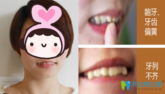 你信嗎?齙牙妹子在蘇州牙博士口腔僅花費7天就完成牙齒矯正