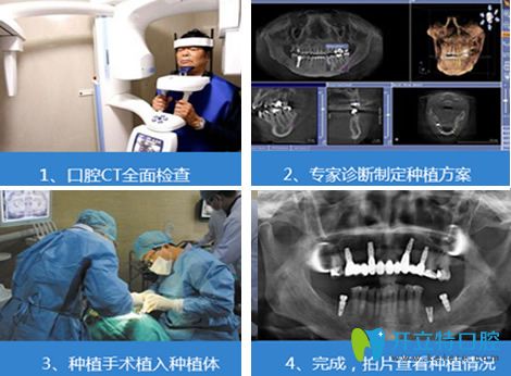 白振鑾主任微創(chuàng)無(wú)痛種植牙過(guò)程