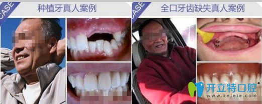 佛山粵冠口腔種植牙真人案例圖