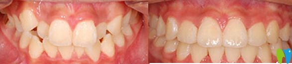好民生口腔牙齒矯正前后效果