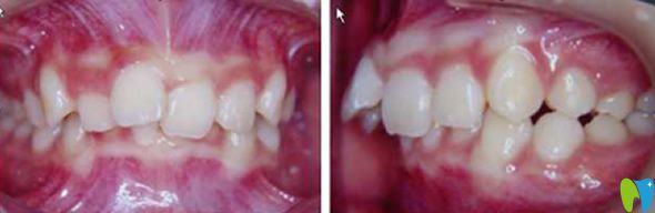 中山好民生口腔沒(méi)做牙齒矯正前的照片