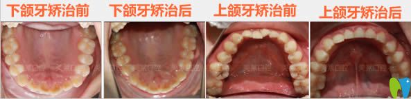 牙齒正畸后下頜牙和上頜牙的前后對比照 牙齒正畸后下頜牙和上頜牙的前后對比照