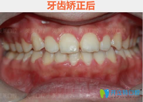 在廣州美萊口腔做完時代天使隱形矯正18個月效果 在廣州美萊口腔做完時代天使隱形矯正18個月效果