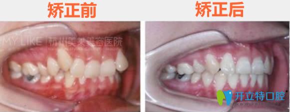 廣州美萊胡祥牙齒矯正前后對(duì)比效果 廣州美萊胡祥牙齒矯正前后對(duì)比效果