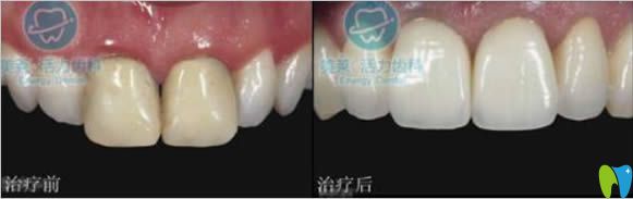 廣州美萊牙科烤瓷牙修復(fù)前后對比效果
