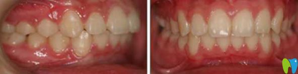 好民生口腔牙齒矯正后的<span style=