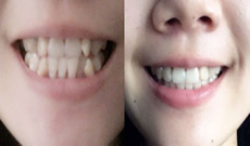 蘇州美奧口腔85后虎牙女在蘇州美奧口腔花1年多完成隱形牙齒矯正的日記