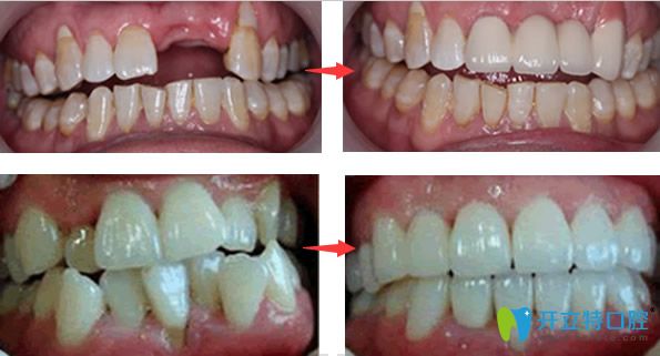 韋博口腔種植牙+牙齒矯正效果案例