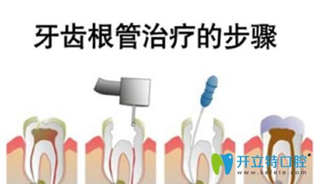 牙齒根管治療步驟和過程 牙齒根管治療步驟和過程