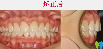 清遠(yuǎn)牙科哪家好  看中大口腔牙齒矯正真人案例效果對(duì)比