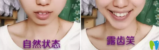 過(guò)了牙齒矯正年齡 我找中山香山口腔譚智堅(jiān)做了矯正