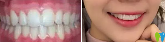 中山香山口腔譚智堅院長給我做隱形牙齒矯正一年的效果