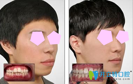 廣州偉聯(lián)口腔牙齒矯正效果對比圖