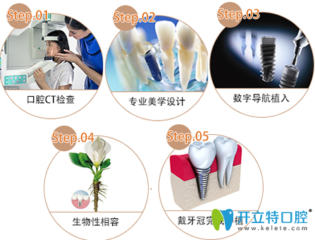 廣州偉聯(lián)口腔種植牙過程圖