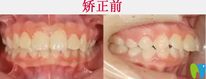 清遠(yuǎn)中大口腔案例牙齒矯正術(shù)前照