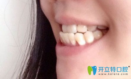 沒有去蘇州美奧口腔做牙齒矯正前側(cè)面照