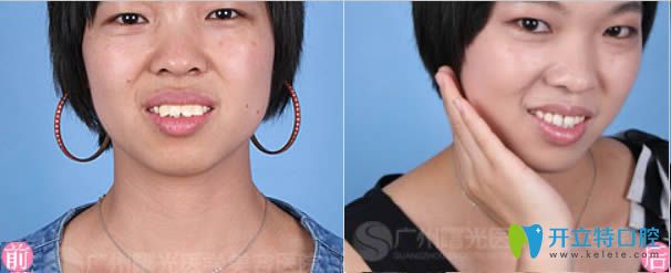 廣州曙光齙牙矯正和超聲波洗牙前后對(duì)比照