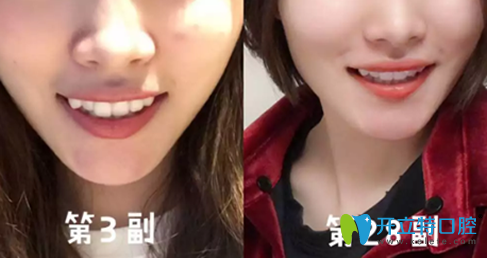 我在廣州德倫口腔做隱適美牙齒矯正過程中