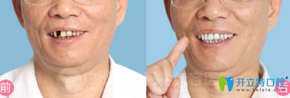 廣州曙光即刻種植牙前后對(duì)比效果