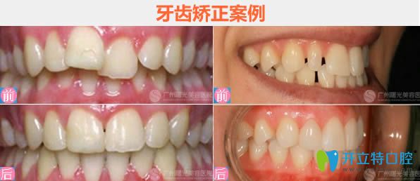 廣州曙光王浩主任隱形牙齒矯正前后對(duì)比效果