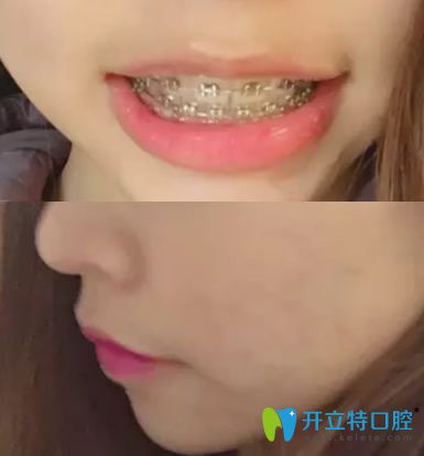 在深圳河山齒科做牙齒正畸一年半效果圖展示
