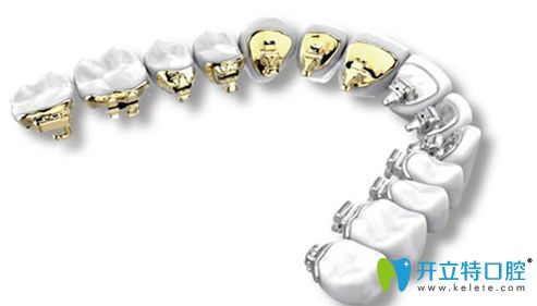 深圳河山齒科無托槽隱形矯正示例圖