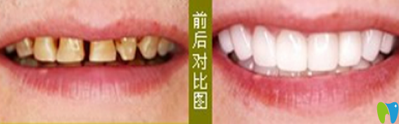 在武漢愛齒爾口腔做牙齒修復治療前后對比圖