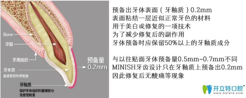 較少磨牙的minish牙齒貼面技術(shù)實(shí)現(xiàn)牙齒美白