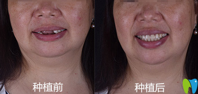廣州好大夫口腔廖崇元種植牙前后效果對(duì)比圖