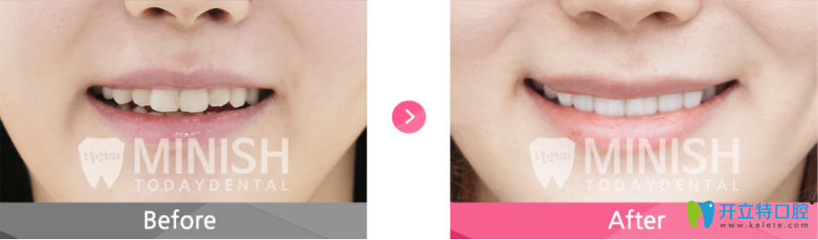 難看牙齒通過minish牙齒設(shè)計的案例對比 難看牙齒通過minish牙齒設(shè)計的案例對比
