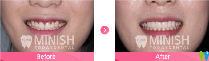 牙齦露出過多難看的minish設(shè)計前后對比案例圖 牙齦露出過多難看的minish設(shè)計前后對比案例圖