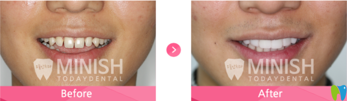 牙齒縫隙大的minish牙齒設(shè)計案例前后對比 牙齒縫隙大的minish牙齒設(shè)計案例前后對比