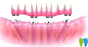 廣州好大夫口腔即刻種植牙技術(shù)介紹