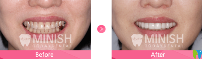 牙齒發(fā)黃的minish美白前后對比 牙齒發(fā)黃的minish美白前后對比