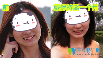 愛(ài)齒爾口腔牙齒矯正前后效果對(duì)比圖 愛(ài)齒爾口腔牙齒矯正前后效果對(duì)比圖