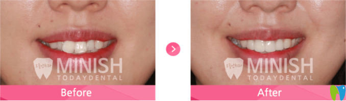 不規(guī)則牙齒的minish案例對比 不規(guī)則牙齒的minish案例對比