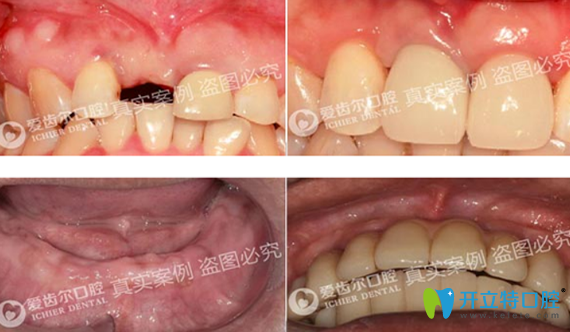 徐安斌單顆牙缺失種植案例+全口牙缺失種植案例