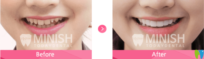 牙齒畸形過小的minish貼面設(shè)計前后對比 牙齒畸形過小的minish貼面設(shè)計前后對比