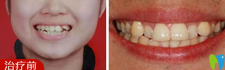 佛山愛頓口腔靠譜嗎？隱形牙齒矯正6個月的效果圖來見證