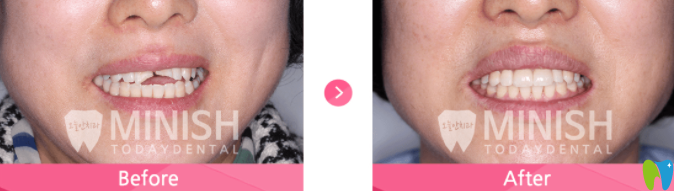 牙齒斷裂的minish設(shè)計前后對比圖片 牙齒斷裂的minish設(shè)計前后對比圖片