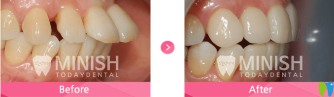 牙齒突出的minish設(shè)計前后對比 牙齒突出的minish設(shè)計前后對比