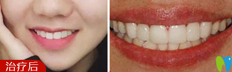 我在佛山愛頓口腔做隱形牙齒矯正6個月效果