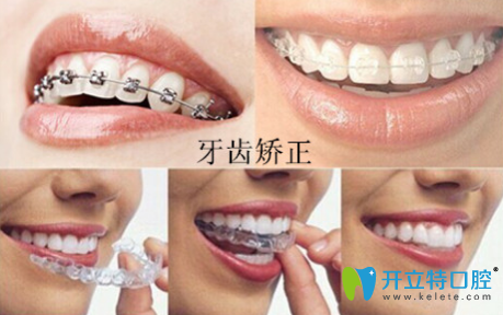 周佩佩科普：“牙齒矯正的年齡是什么時候？”