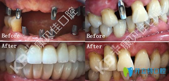 康貝佳院長李振芳多顆牙缺失CT親骨種植技術(shù)修復+單顆牙缺失即刻種植案例
