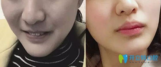 北京康貝佳口腔牙齒矯正前后對比圖