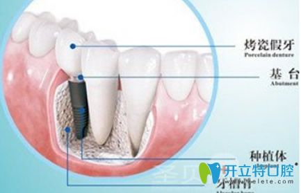 　種植牙由種植體基臺(tái)烤瓷冠三部分組成部分