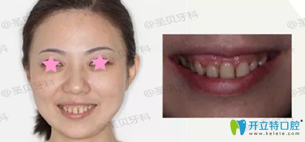成都圣貝齒科露齦笑矯正前 成都圣貝齒科露齦笑矯正前