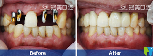 北京冠美口腔多顆牙種植前后效果對(duì)比圖